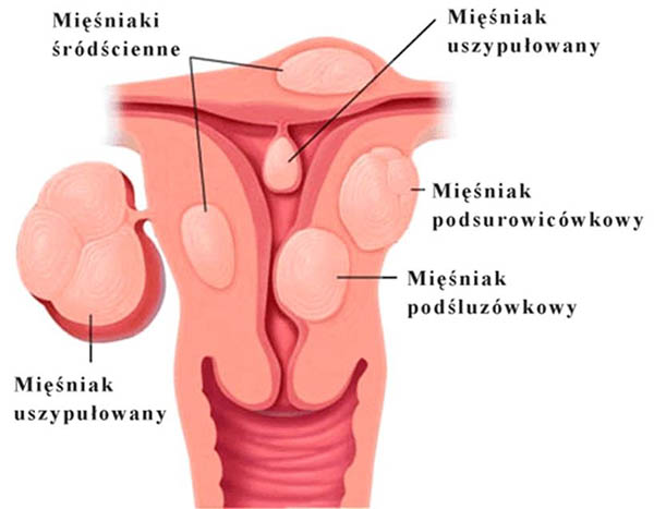 mięśniak macicy - nowotwór łagodny